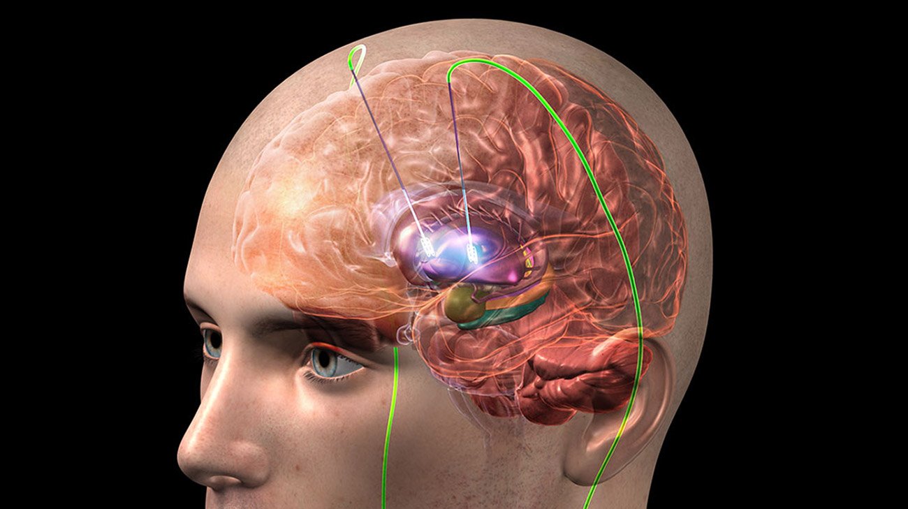 La Estimulación Cerebral Profunda: Un Avance en la Rehabilitación del Habla y la Deglución tras Lesiones Cerebrales Traumáticas